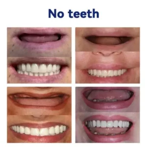 OHNEEN™ – 🦷Fortschrittliches Maßgeschneidertes Vollprothesen-Set🦷 (⏰Zeitlich begrenzter Rabatt⏰)