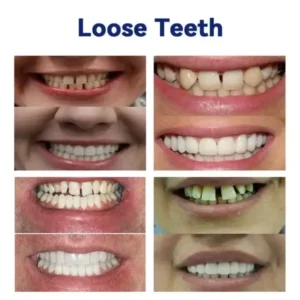 OHNEEN™ – 🦷Fortschrittliches Maßgeschneidertes Vollprothesen-Set🦷 (⏰Zeitlich begrenzter Rabatt⏰)