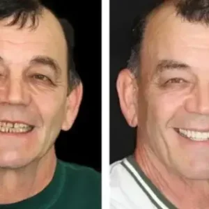 Smileasego™ -🦷Advanced Customized Full Denture Set🦷 (⏰Limited time discount last 30 minutes⏰)