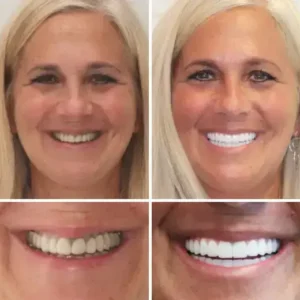 Smileasego™ -🦷Advanced Customized Full Denture Set🦷 (⏰Limited time discount last 30 minutes⏰)