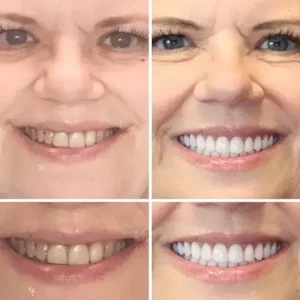 Smileasego™ -🦷Advanced Customized Full Denture Set🦷 (⏰Limited time discount last 30 minutes⏰)