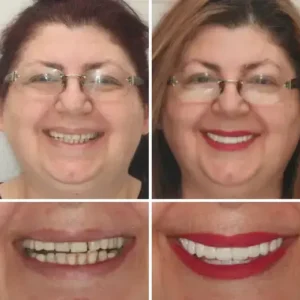 Smileasego™ -🦷Advanced Customized Full Denture Set🦷 (⏰Limited time discount last 30 minutes⏰)