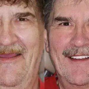 Smileasego™ -🦷Advanced Customized Full Denture Set🦷 (⏰Limited time discount last 30 minutes⏰)
