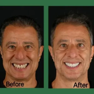 Smileasego™ Oral Gum Treatment Toothpaste Tablets