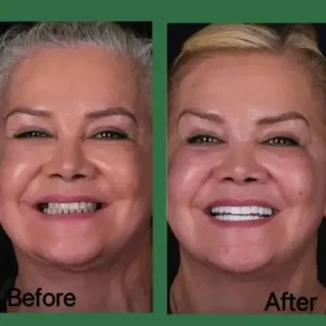 Smileasego™ Oral Gum Treatment Toothpaste Tablets