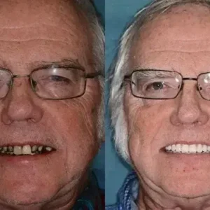 Smileasego™ Premium Dentures